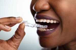 Invisalign Costs Explained: Honest Breakdown of Pricing & Value