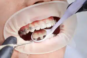 Braces Journey: 6 Proven Steps for a Smooth Experience