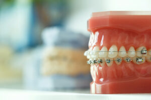 Braces Bloomington IL Treatment Options