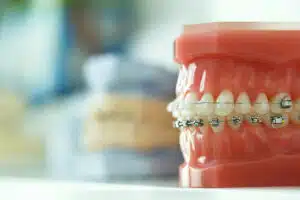 Braces Bloomington IL Treatment Options