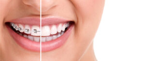 Braces Bloomington IL Treatment 
