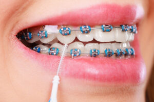 Braces Care Tips for Clean and Healthy Teeth