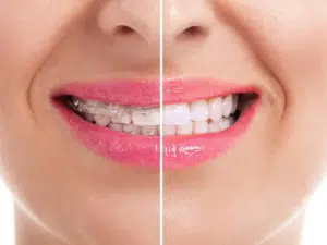braces before and after smile results at Bowers Orthodontics