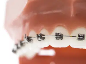 Braces Treatment Time for Adults