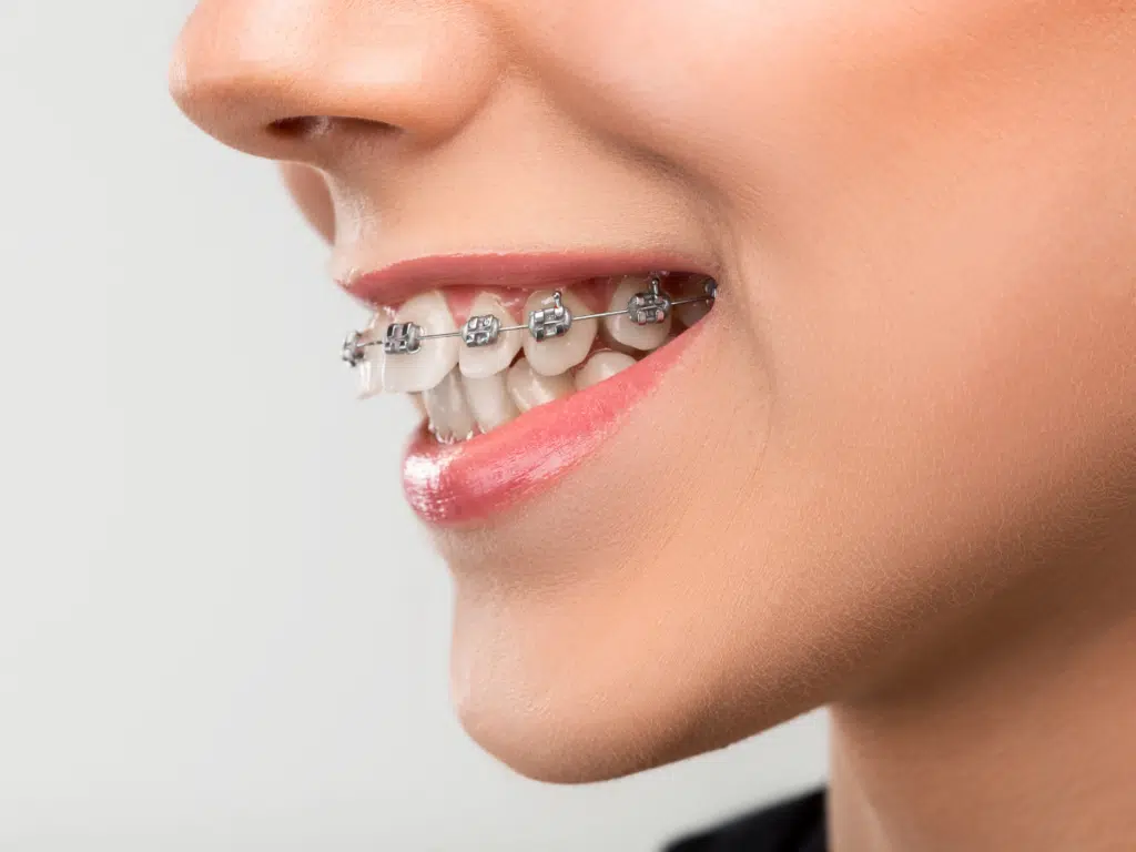 smiling with braces during orthodontic treatment in Bloomington IL