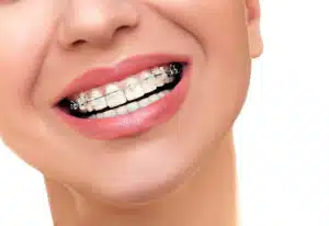 Close-up of a smiling adult patient wearing braces showing orthodontic treatment for adults