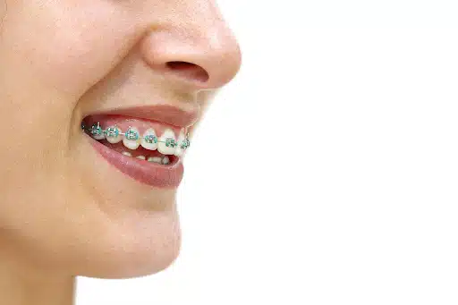 braces