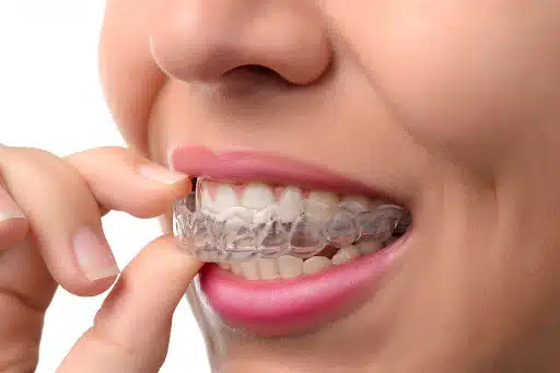 iNVISALIGN