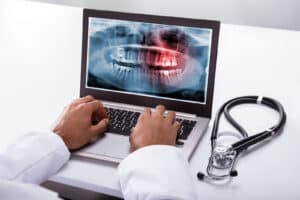 Doctor in a white lab coat using a laptop to view a digital panoramic dental X-ray with a red highlighted area