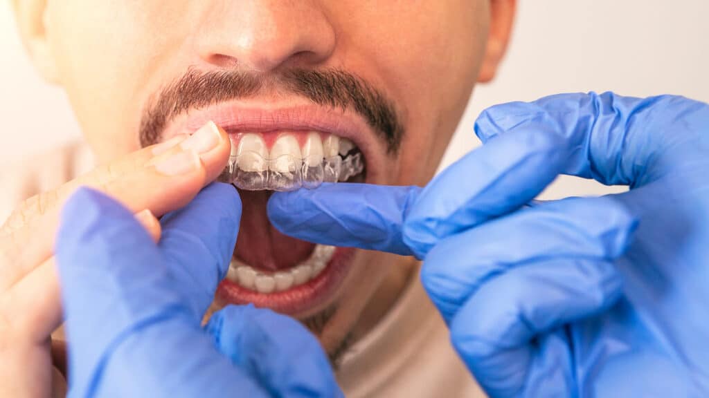 Orthodontist wearing blue gloves fitting a clear plastic aligner onto a male patient's upper teeth