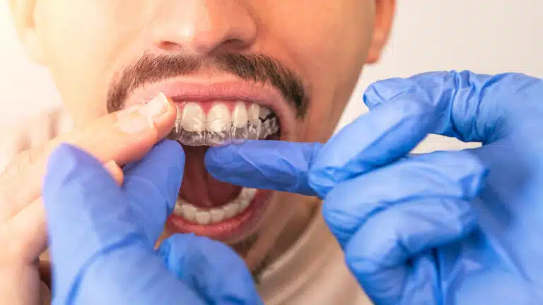 Orthodontist wearing blue gloves fitting a clear plastic aligner onto a male patient's upper teeth