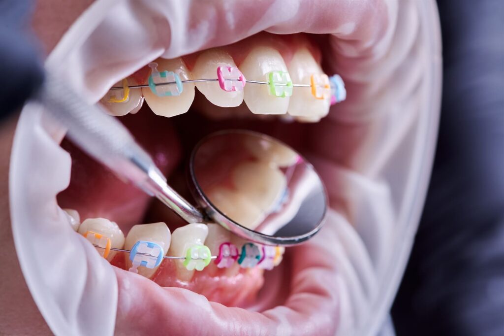 Extreme close-up of teeth with colorful orthodontic braces being examined