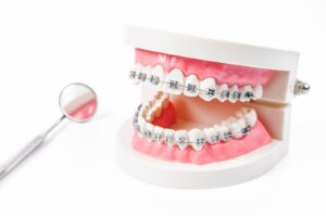 Anatomical dental model of human teeth with metal braces