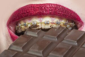 Person with metal braces biting into a bar of dark chocolate