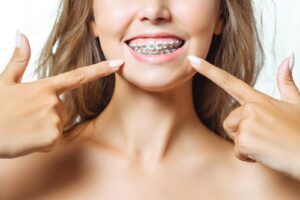 Close-up of a smiling woman pointing her fingers toward her orthodontic braces