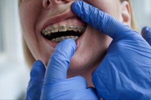 An orthodontist in blue gloves checking a patient's metal dental braces