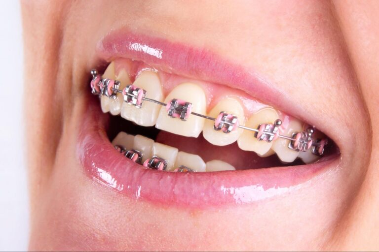Close-up of a smile showing dental braces with pink bands