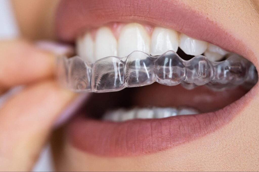 Close-up of a person inserting a clear plastic aligner onto their teeth