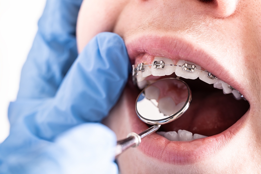 Close-up of orthodontic braces